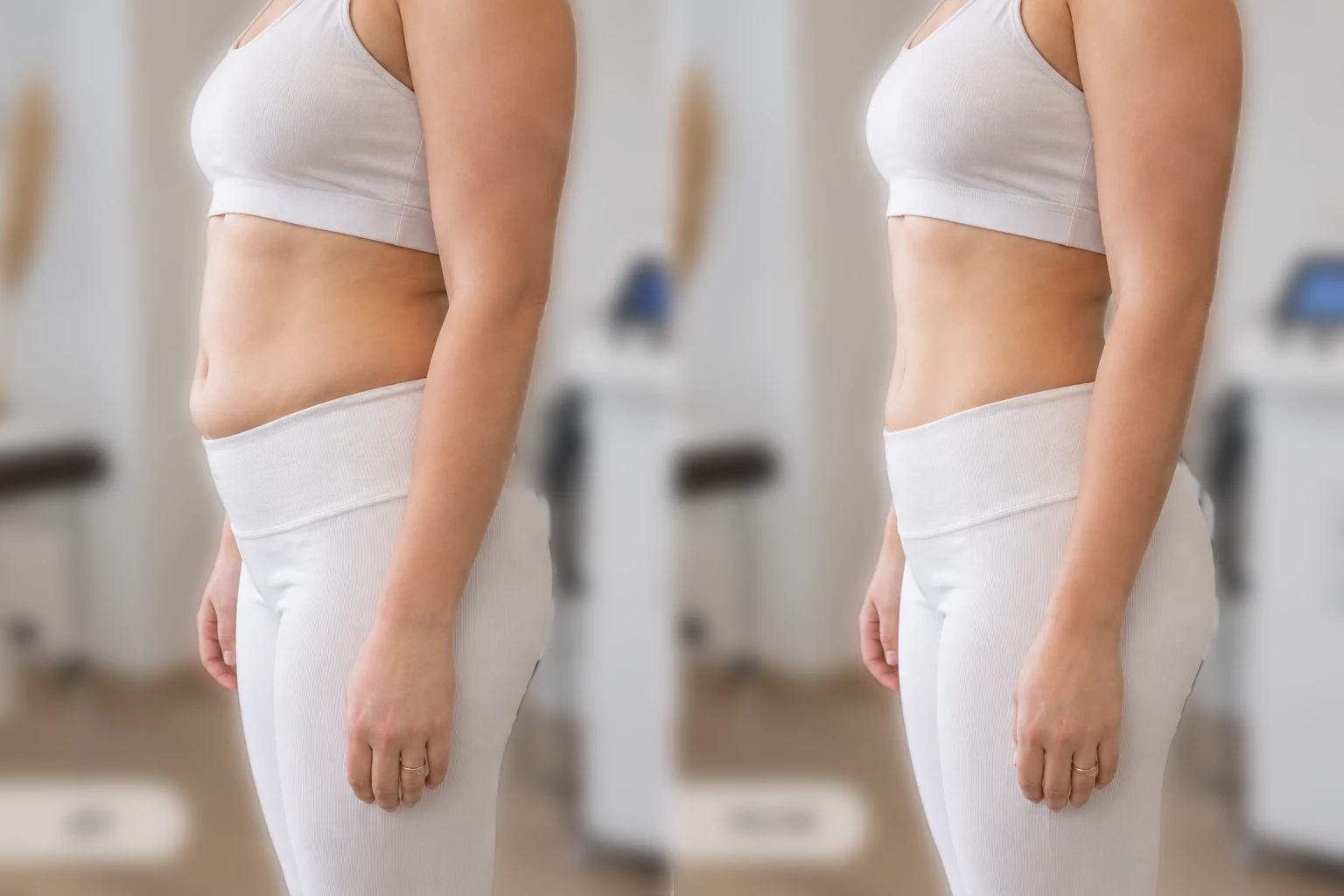EMSCULPT body-contouring result before and after