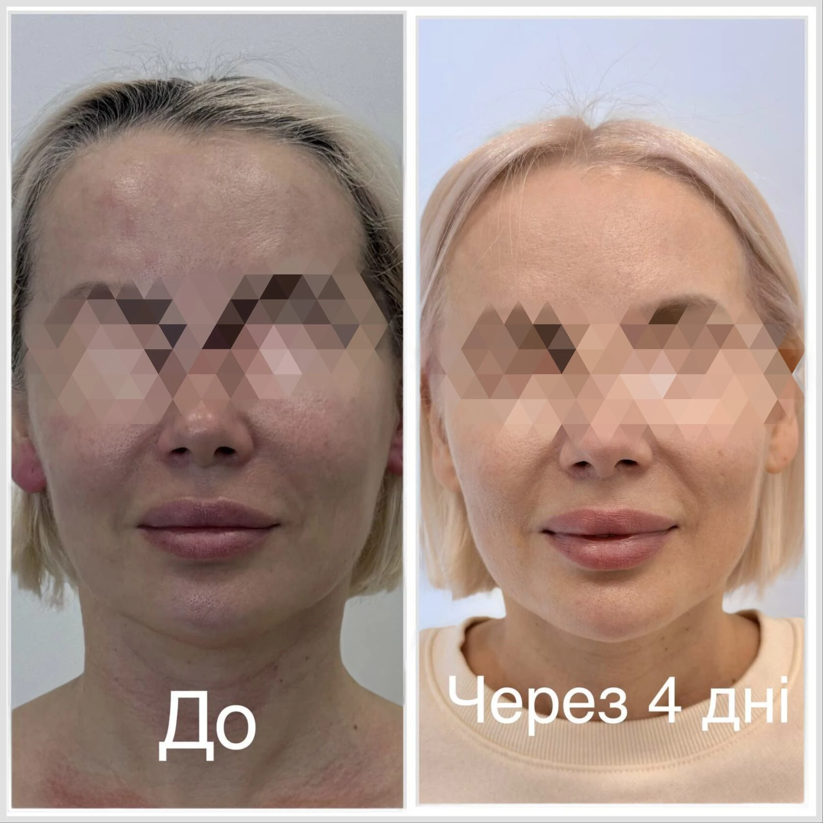 Fractional microneedle RF treatment result before and after