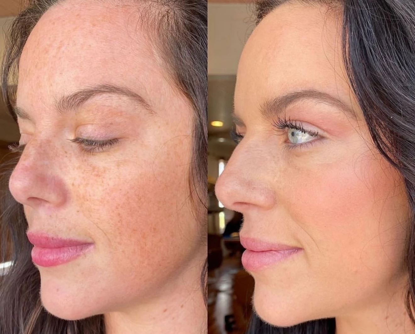 IPL photorejuvenation result before and after a treatment course